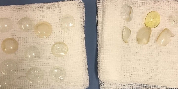 Gözünden 27 kontakt lens çıkarıldı