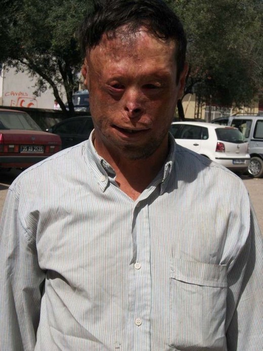 Turan Çolak 3,5 yaşındayken ocağa düşmesi sonucu yüzünü kaybetmişti