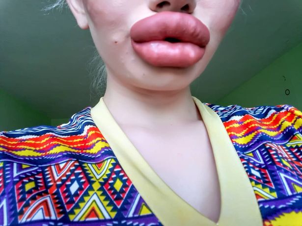 Ivanova, ülkenin başkenti Sofya’daki neredeyse tüm estetik kliniklerini ziyaret ettiğini ve her çeşit dudak dolgusu operasyonunu yaptırdığını ekledi.