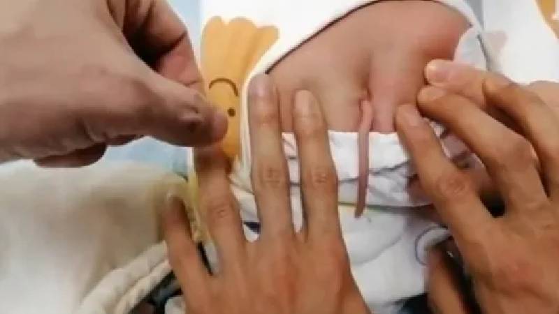 Bebek, sırtında 10 santimlik bir kuyrukla dünyaya geldi