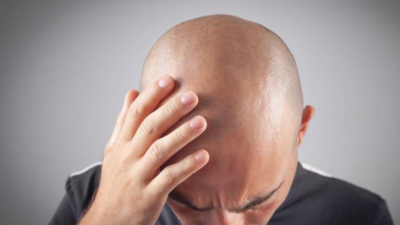 Baldness Breakthrough: Promising New Treatment