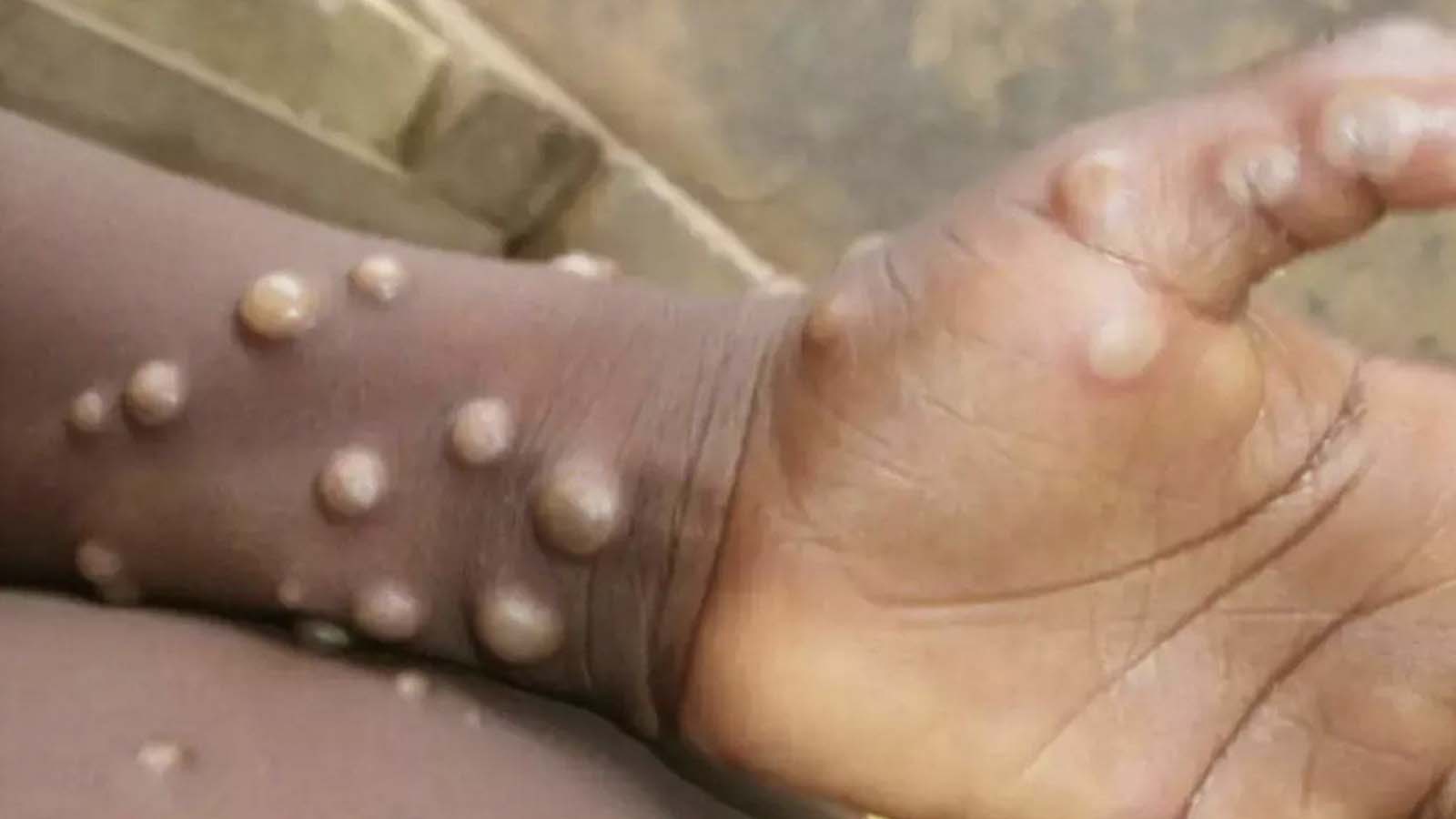 Uganda, "M Çiçeği" virüsüne karşı aşı kampanyası başlattı