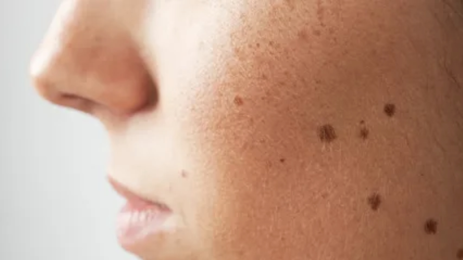 Dermatoloji Uzmanı açıkladı: Cilt lekeleri yazdan sonra belirginleşiyor