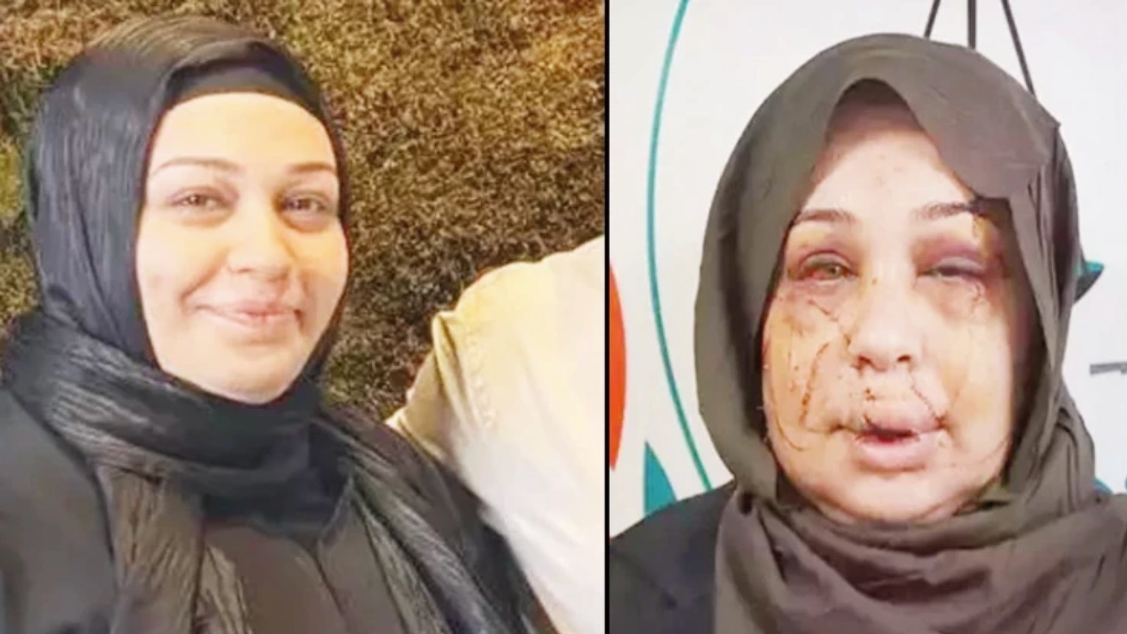 Evli olduğu kadına şiddet uygulayan Cumhurbaşkanı Koruma Dairesi personeli Çakmak'ın ifadesi: Arbedede tırnak makasıyla yaralandı 