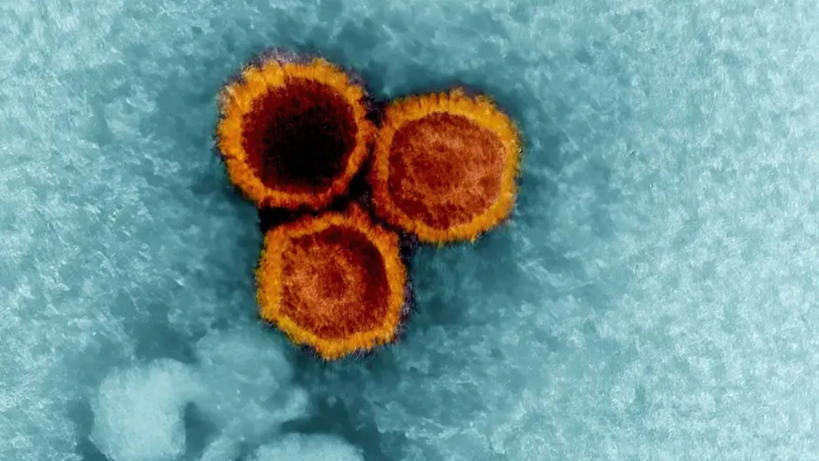 MS hastalığına kimler neden yakalanıyor?