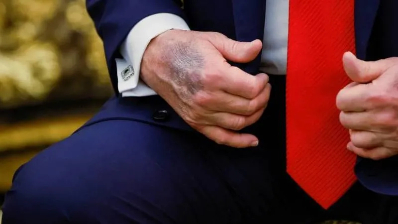 Trump elindeki morlukların sebebini açıkladı; yüksek doz aspirin!