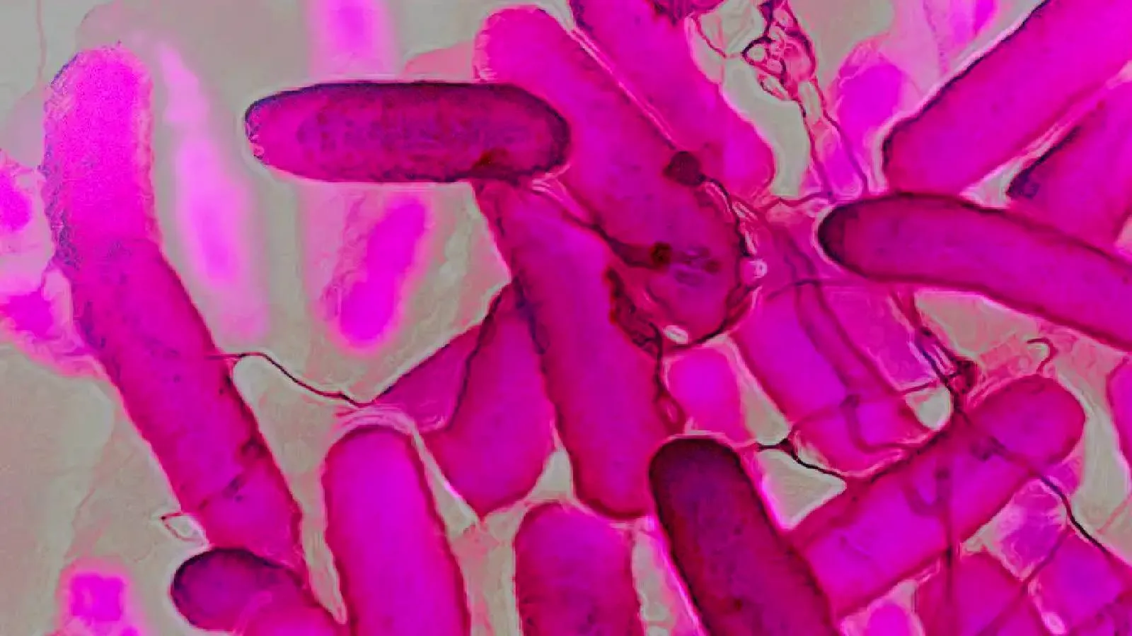 İçmeden sarhoşluk: Bağırsak kaynaklı nadir hastalık