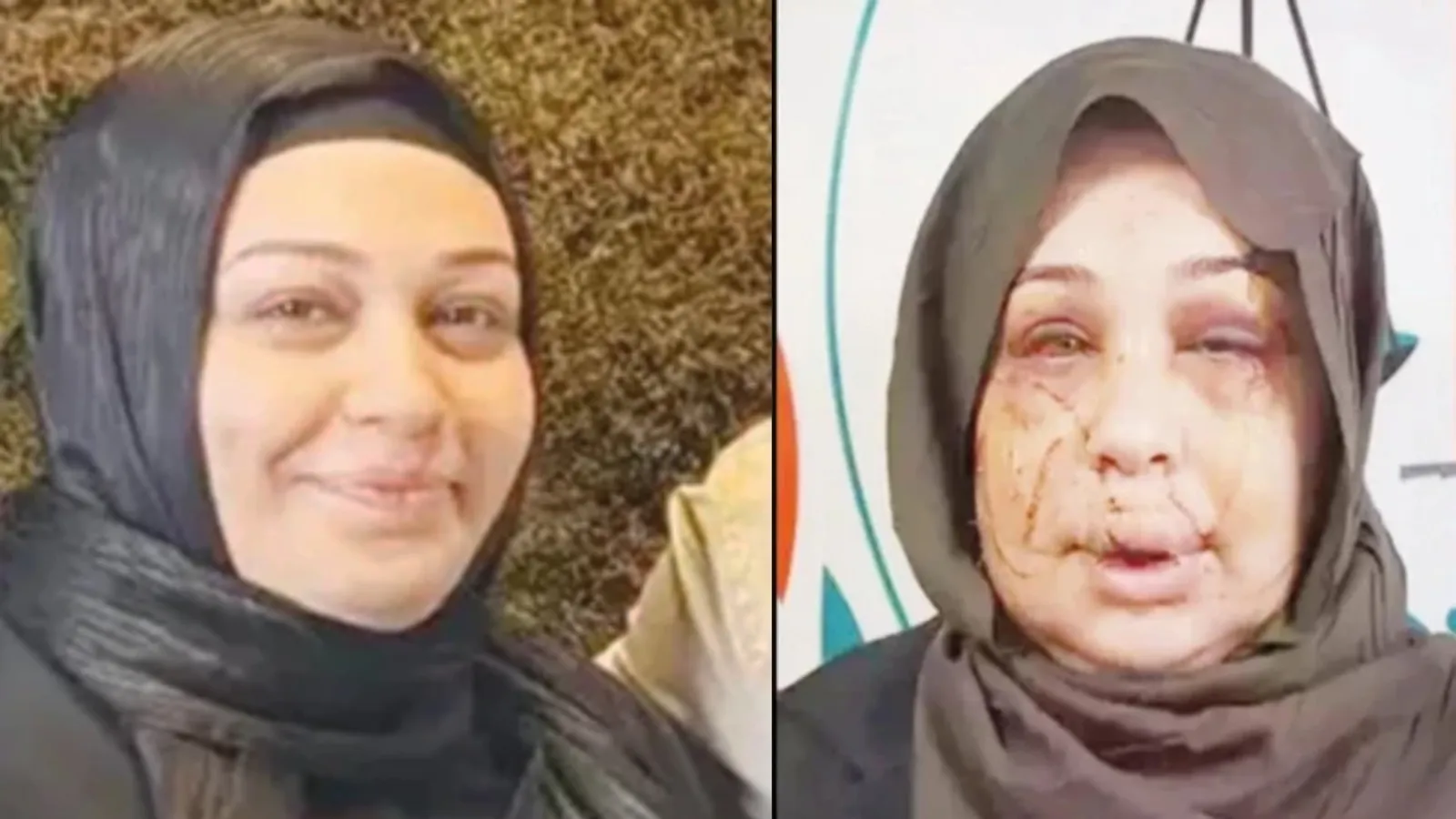 Boşanmak isteyen eşinin yüzünü kesen polis memuru Yasin Çakmak için 15 yıl hapis istemi
