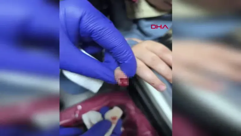 AVM'de yürüyen merdivene eli sıkışan çocuğun parmağı koptu