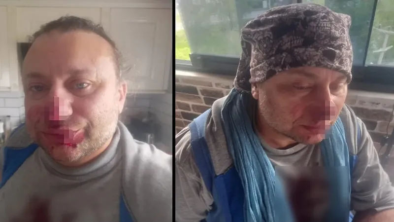 Köpek saldırısının ardından "et yiyen bakteri" şüphesi: Onur Akay entübe edildi