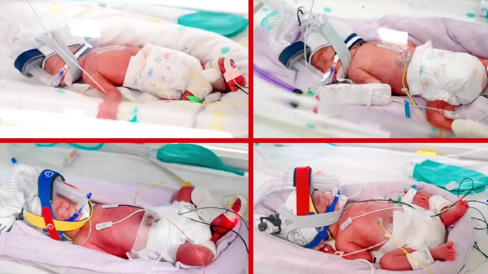 15 milyonda bir ihtimal gerçekleşti: Doğal yolla gebe kalan kadın tek yumurta dördüzleri doğurdu