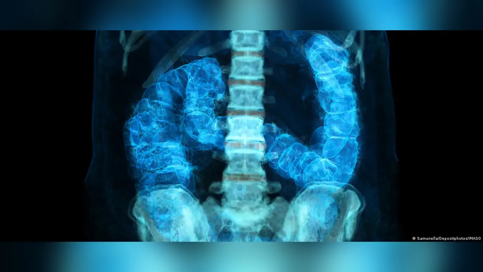 50 yaş altındaki kanser vakaları neden artıyor?